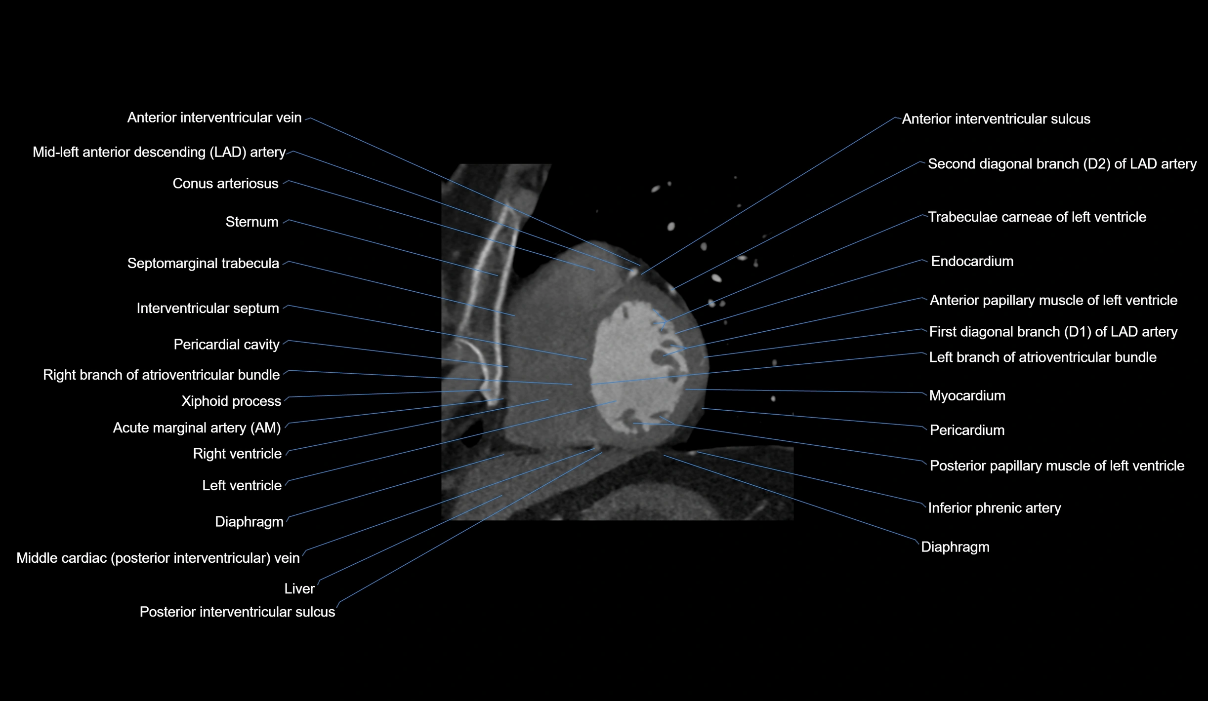 CT heart (coronary angiogram) short axis view  cross sectional anatomy labelled radiology image-00035.webp